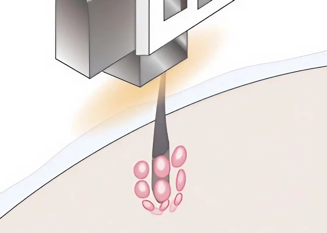 ENCHANTERの光脱毛の仕組み：STEP.05